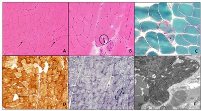 Neuropathic Pain as Main Manifestation of POLG-Related Disease: A Case Report